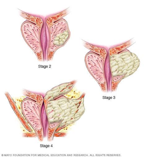 Stage 4 prostate cancer symptoms and causes – Artofit