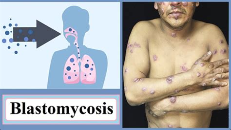 Herbal Remedies for the Treatment of Blastomycosis