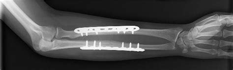 Internal Fixation for Fractures - OrthoInfo - AAOS