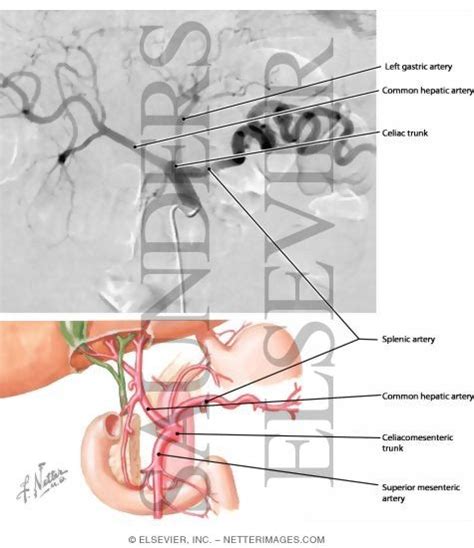 Celiac Trunk, Normal and Variant