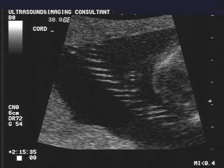 Hypercoiled Umbilical Cord Ultrasound