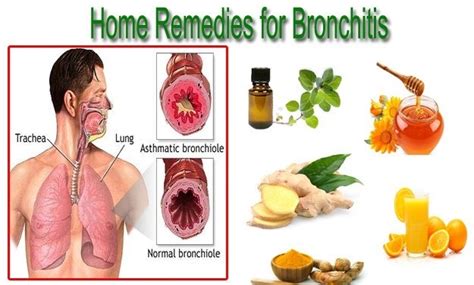 bronchitis natural remedies - Philadelphia Holistic Clinic