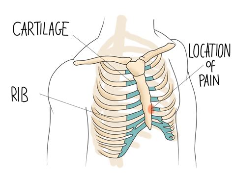 Costochondritis: Rib Pain - Gemini Osteopathy