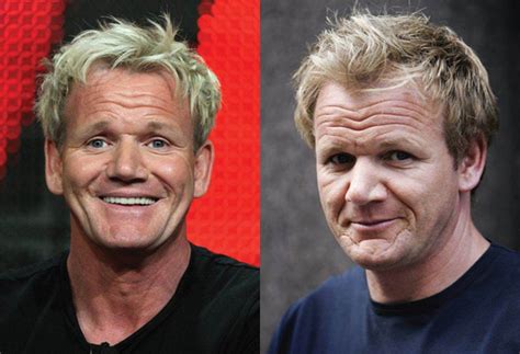 Gordon Ramsay Before And After Hair Transplant