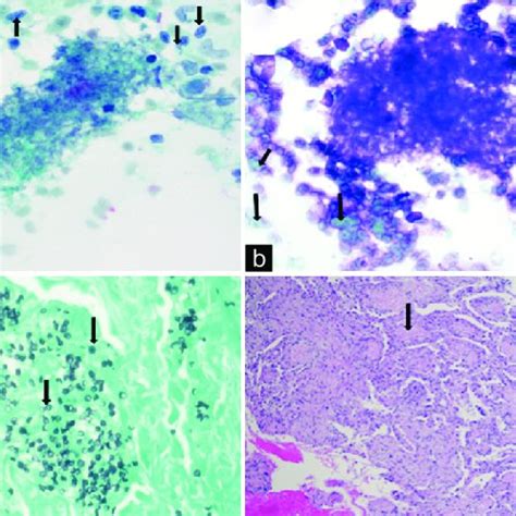 Pictures documenting appearance of pneumocystis in various cytologic ...