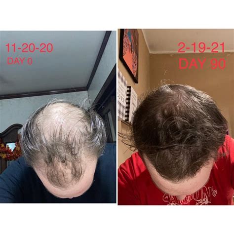 3 Month results w/ Finasteride & Minoxidil : r/malehairadvice