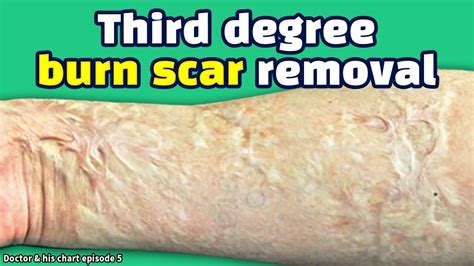 [scar clinic in korea]Burn scar(arm) removal treatment -Third degree ...