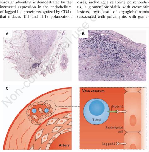 -Biopsies of arteries of patients with GCA. Inflammatory infiltrate ...