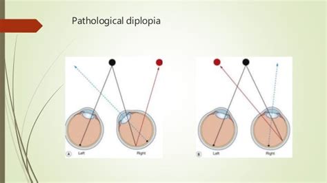 Evaluation of a patient with diplopia