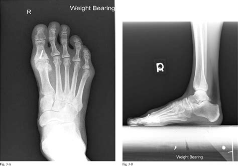 Figure 3 from Treatment of Advanced Stages of Hallux Rigidus with Cheilectomy and Phalangeal ...