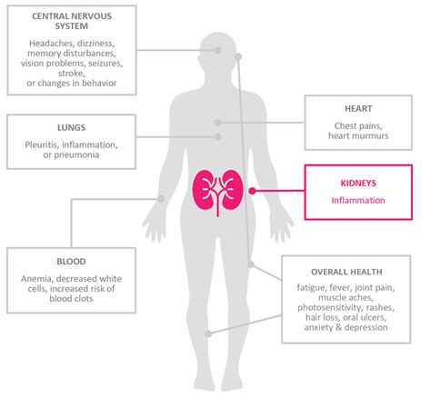 What Is Lupus Nephritis? | ALL IN for Lupus Nephritis