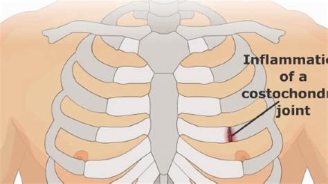 Costochondritis : Cuase,Symptoms, Diagnosis, Treatment, Physiotherapy