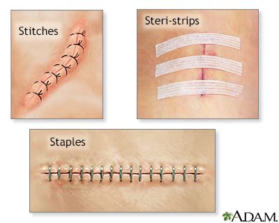 Laceration - sutures or staples - at home