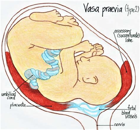 Vasa previa definition, causes, symptoms, diagnosis, ultrasound ...