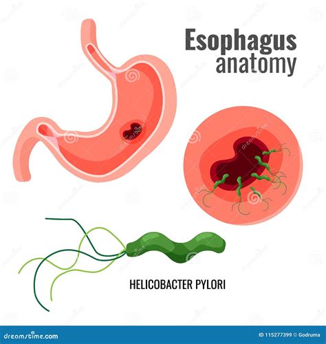 Esophagus Anatomy and Helicobacter Pylori Medical Promo Poster Stock Vector - Illustration of ...