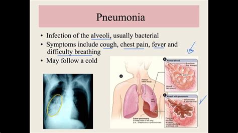 Unit 13.2 Respiratory System Disorders - YouTube