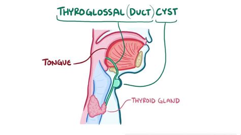 Thyroglossal duct cyst: Video, Anatomy & Definition | Osmosis