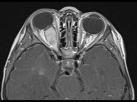 Optic Nerve Glioma - YouTube