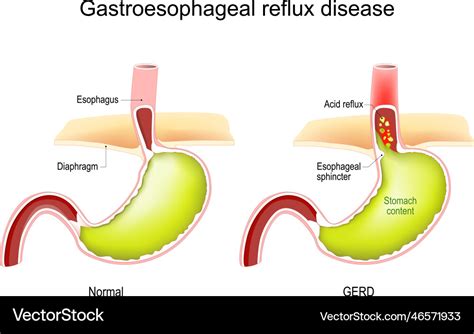 Gastroesophageal reflux disease gerd Royalty Free Vector