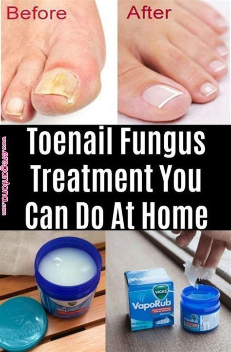 Toenail Fungus Treatment You Can Do At Home | Fungos nas unhas, Remédio ...