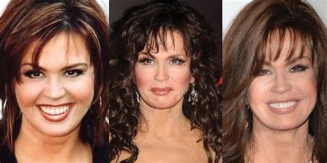 Marie Osmond Plastic Surgery Before and After Pictures 2024