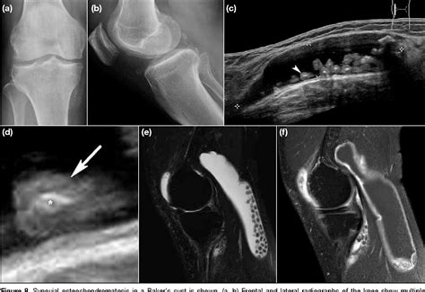 Figure 8 from Sonography of Baker’s Cyst (Popliteal Cyst): the Typical and Atypical Features ...