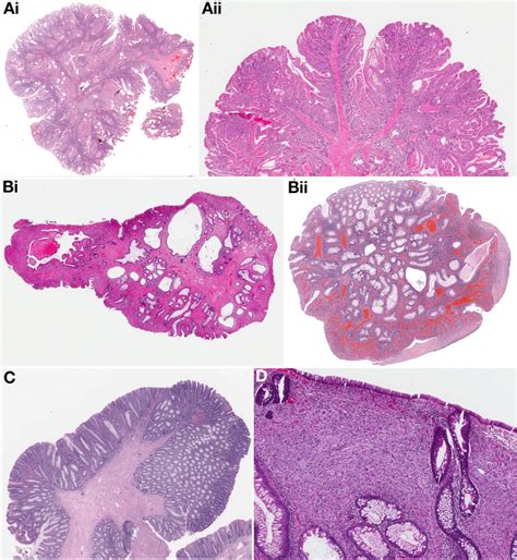 Colorectal cancer Archives - American Gastroenterological Association