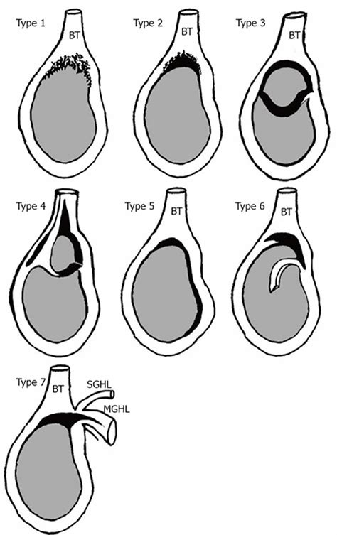 Labrum cartilage tear shoulder, causes, symptoms, diagnosis & treatment