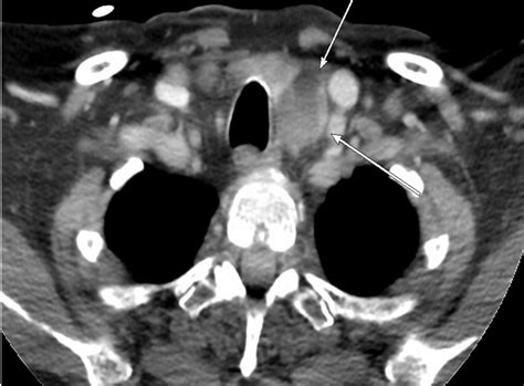 Cureus | A Rare Case of Severe Hypercalcemia Secondary to Atypical Parathyroid Cystic Adenoma ...