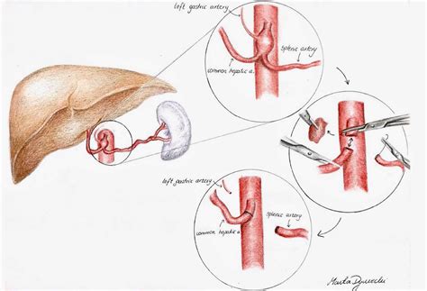 Surgical repair of a symptomatic celiac artery aneurysm with resection and end-to-end ...