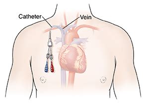 Central Line (Central Venous Access Device) | Saint Luke's Health System