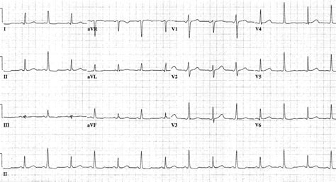 Cardiac Tamponade Ecg Strip