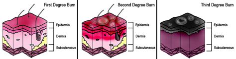 [Figure, Diagram of Burn Degrees Contributed by Wikimedia Commons ...