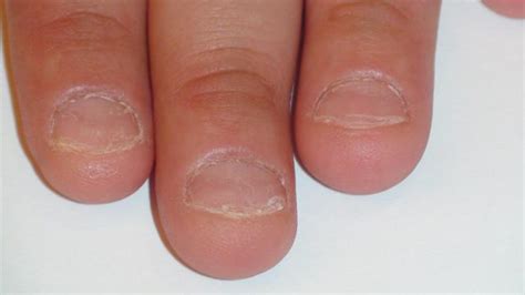 NAIL DISEASES - Onychotillomania picture | Hellenic Dermatological Atlas - Over 2700 Dermatology ...