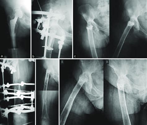 Radiograph of right hip joint anteroposterior view of a 43 year old ...