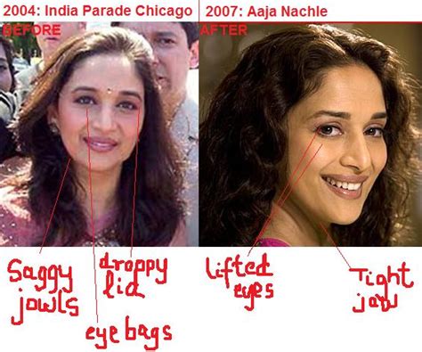 Madhuri Dixit Plastic Surgery : Bollywood Actresses Before And After ...