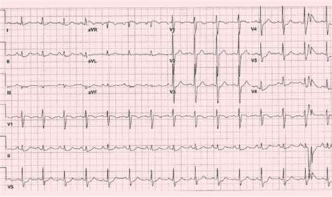 Polymorphic Ventricular Tachycardia Ecg