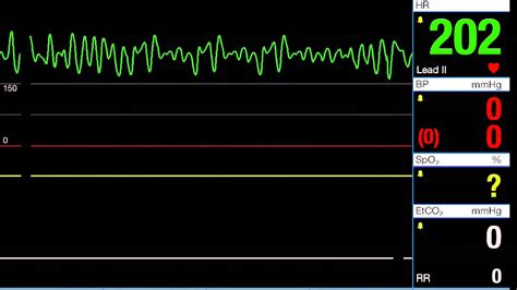 Ventricular Fibrillation - V-Fib - YouTube