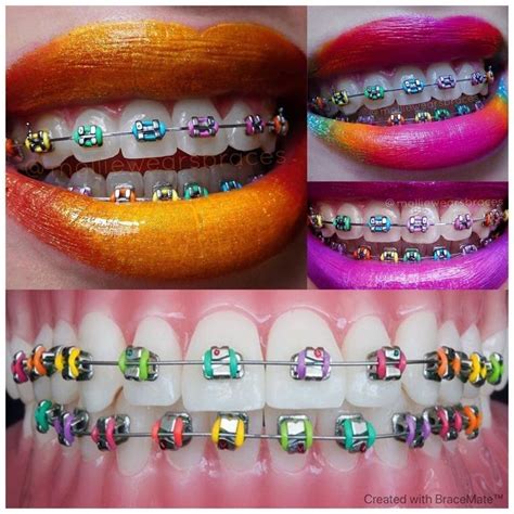 Brace faces | Braces colors, Braces teeth colors, Rainbow braces