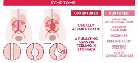 abdominal aortic aneurysm treatment, abdominal aortic aneurysm symptoms, abdominal aortic ...