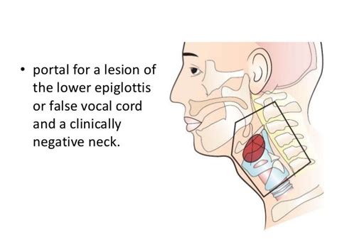 malignancies of the larynx