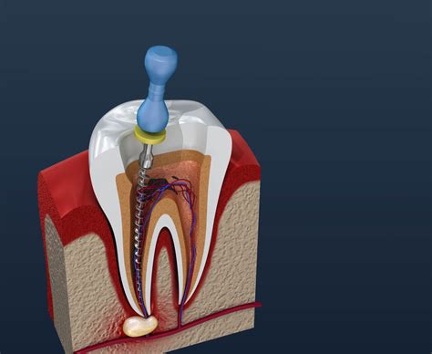 Dental laughing gas as sedation option for root canal treatment