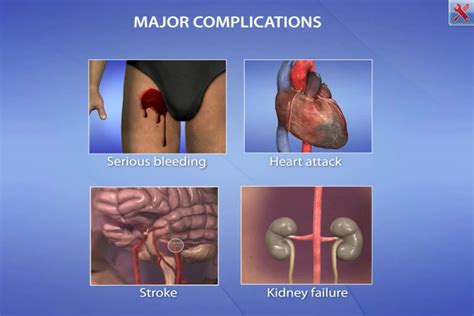 Cardiac Catheterization app uses visual animations for patient ...