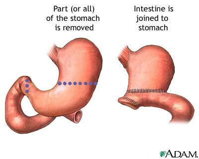 Anastomosis Information | Mount Sinai - New York