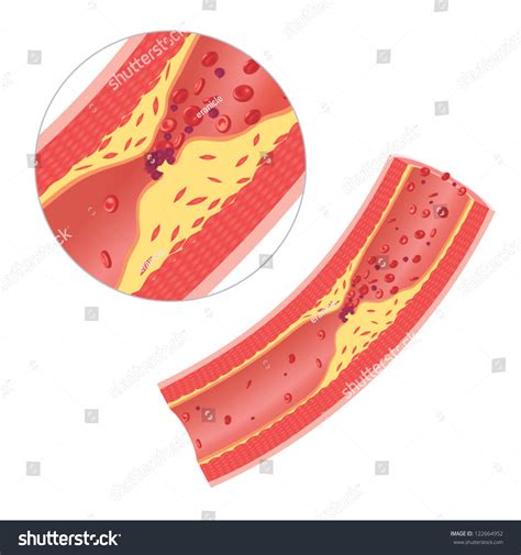 Atherosclerosis Artery Caused By Cholesterol Plaque Stock Vector 122664952 - Shutterstock