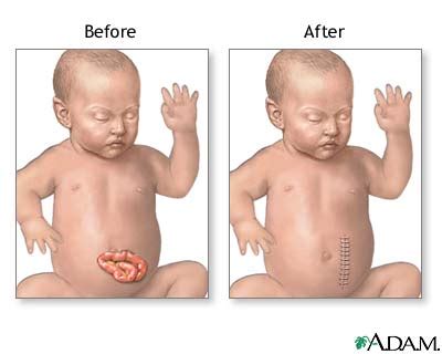 Gastroschisis repair - series—Aftercare: MedlinePlus Medical Encyclopedia