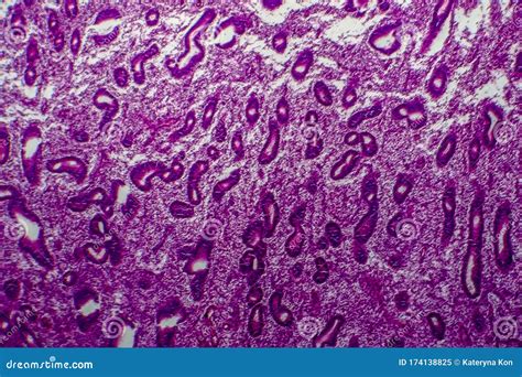 Endometrial Hyperplasia, Light Micrograph Stock Image - Image of glands, histology: 174138825