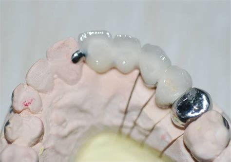 The titanium crowns in dentistry cad-cam application - Dental Lab Shop