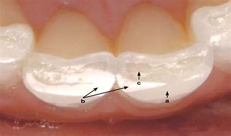 Wear can tell you what the patient does with his or her teeth.... | Download Scientific Diagram