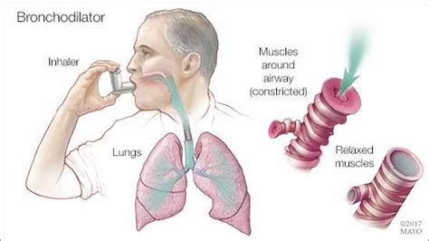 Mayo Clinic Q and A: COPD treatment with two types of bronchodilators ...